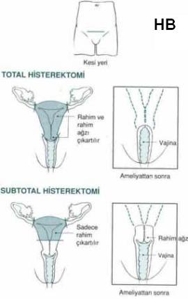 histerektomi nedir