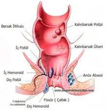 iç hemoroid nedir dış hemoroid nedir basur nedir basur nasıl olur hemoroid nasıl oluşur