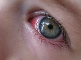 göz kanlanması neden olur, göz kızarıklığı