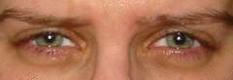 göz kapağı şişmesi göz kapağındaki şişiklik gözde kapakta şişlikler