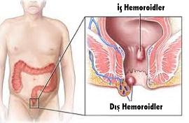 hemoroid tedavi edilmezse ne tür sorunlara yol açar hemoroid tedavisi şart mıdır