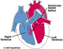 vsd , ventriküler septal defekt