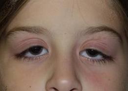 göz kapakları neden şişer göz kapaklarında şişlik neden olur