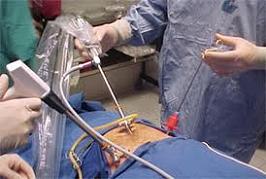 varikosel ameliyatı varikoselin tedavisi varikosel operasyonu