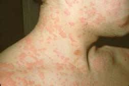 ürtiker nedir, ürtikerin tedavisi, allerjik döküntü hastalığı, alerjinin nedenleri