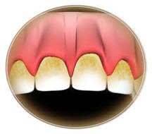 plak nedir diş plağı nasıl oluşur dişlerdeki sarı lekeler