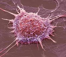 rahim kanseri nedir rahim kanseri nasıl teşhis edilir nasıl anlaşılır
