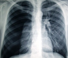 pnömotoraks akciğer resmi