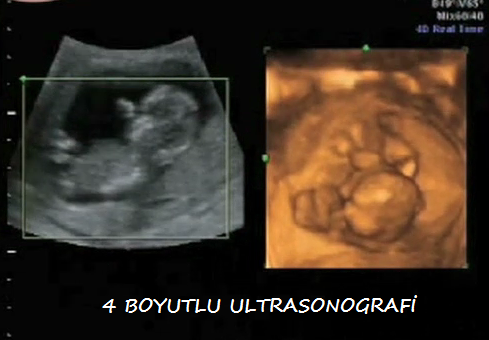 dört boyutlu ultrason , 4 boyutlu ultrasonografi , gebelikte ultrason